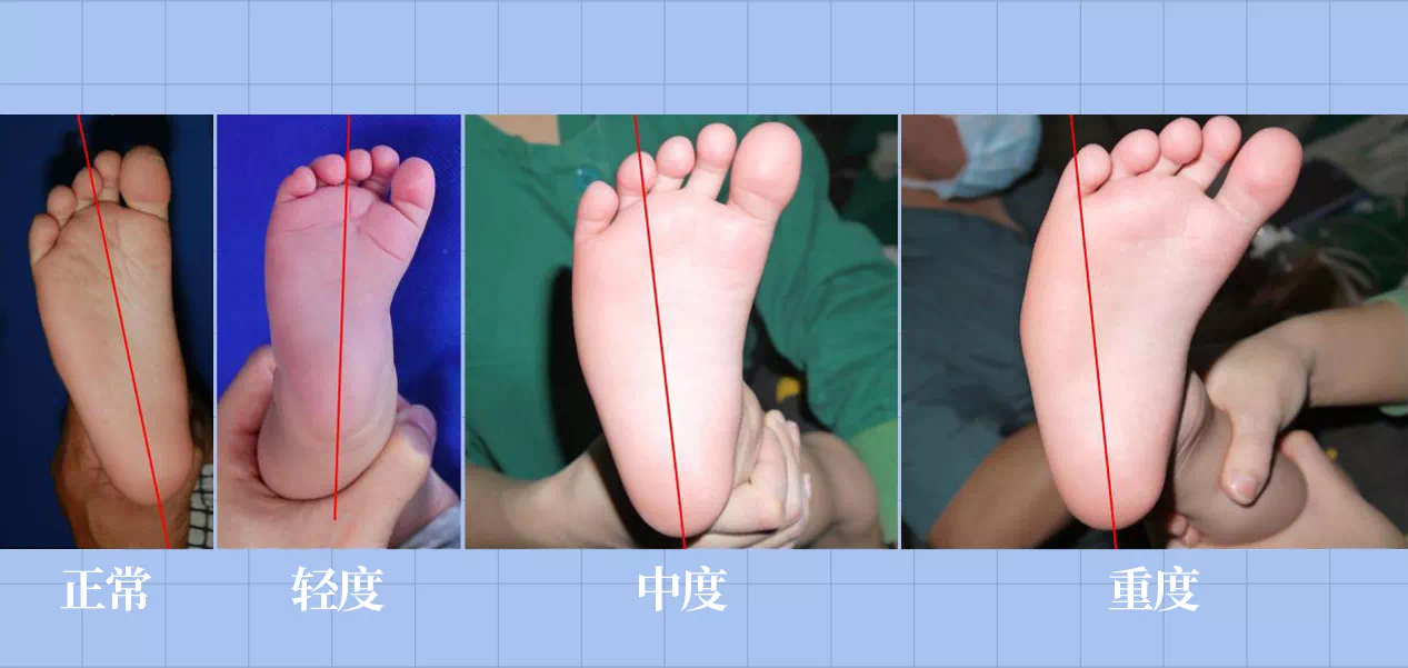 SPI足底壓力分布計(jì)量